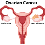 ovarian-cancer